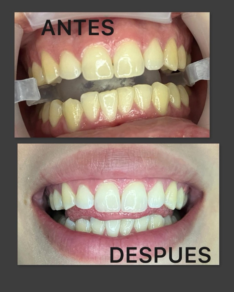 Caso Real 1 - Antes y Después